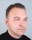 Before Hair Transplant&nbsp;Temporal Hairline
